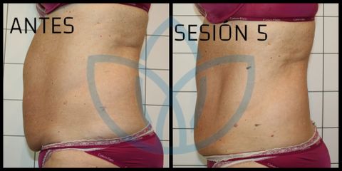 Celulitis - Clínicas Inneo