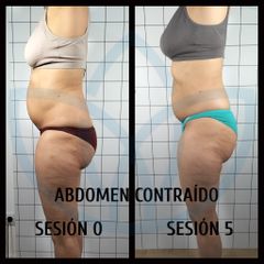 Abdominoplastia - Clínicas Inneo