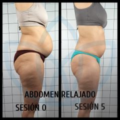 Abdominoplastia - Clínicas Inneo
