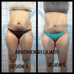 Abdominoplastia - Clínicas Inneo