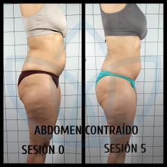 Abdominoplastia - Clínicas Inneo