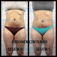 Abdominoplastia - Clínicas Inneo