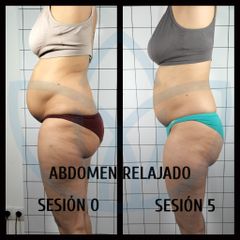 Abdominoplastia - Clínicas Inneo
