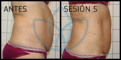 Celulitis - Clínicas Inneo