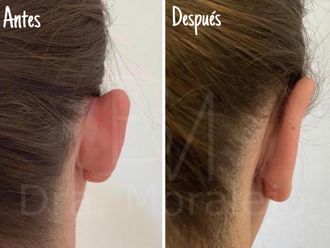 Otoplastia - 648795