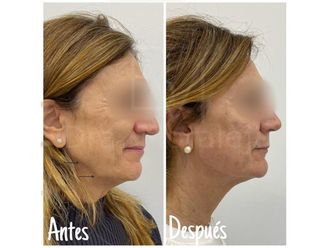 Lipofilling - 648900