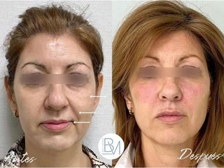 Antes y después Rellenos faciales - Dra. Beatriz Moralejo