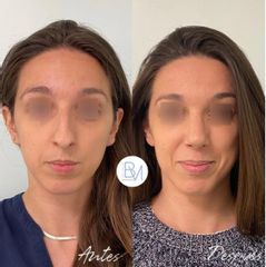 Antes y después Rinoplastia ultrasonica - Dra. Beatriz Moralejo