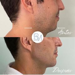 Antes y después Masculinizacion mandibular hialuronico en mandibula y menton - Dra. Beatriz Moralejo