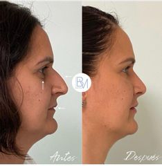 Rinoplastia, relleno de ojeras y de labios con hialuronico - Dra. Beatriz Moralejo