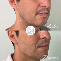 Antes y después Masculinizacion mandibular hialuronico en mandibula y menton - Dra. Beatriz Moralejo