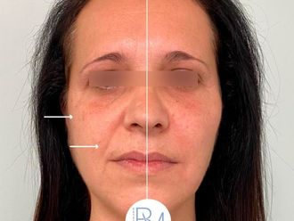 Rellenos faciales - 786281