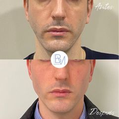 Masculinizacion mandibular hialuronico en mandibula y menton - Dra. Beatriz Moralejo