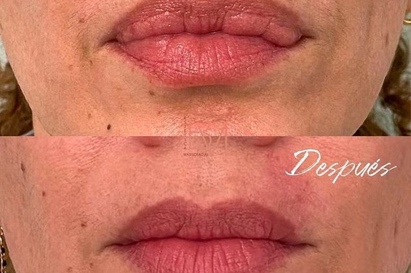 Queiloplastia antes y después - 796086