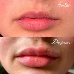 Aumento de labios - Dra. Beatriz Moralejo