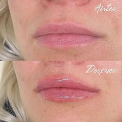 Aumento de labios - Dra. Beatriz Moralejo
