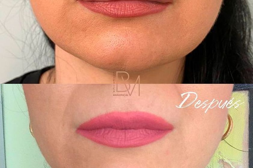 Queiloplastia antes y después - 800188