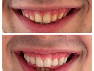 Blanqueamiento dental - 790926