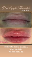 antes y después aumento de labios