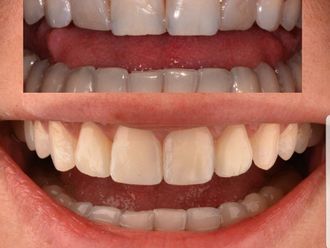 Blanqueamiento dental - 791062