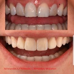 Blanqueamiento dental - Nágila Fernandes