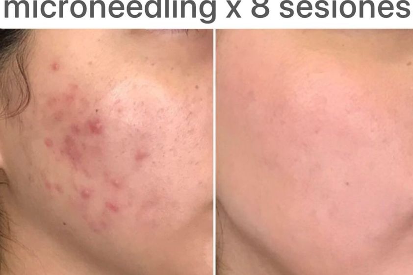 Microneedling antes y después - 792939