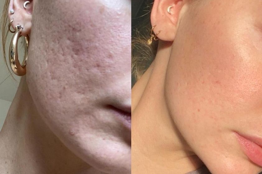 Microneedling antes y después - 796804
