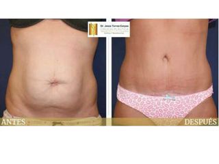 Antes y después Abdominoplastia
