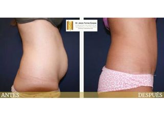 Antes y después Abdominoplastia