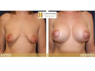 Antes y después Aumento pexia periareolar