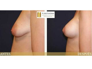 Antes y después Aumento pexia periareolar