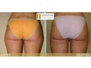 Antes y después Liposucción