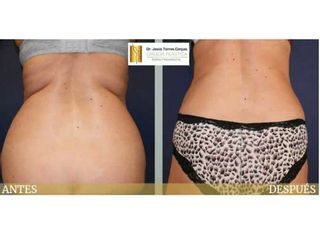 Antes y después Liposucción