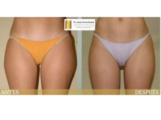 Antes y después Liposucción