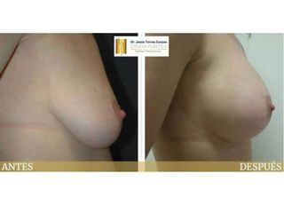 Antes y después Mastopexia con prótesis