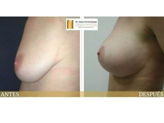 Antes y después Mastopexia con prótesis
