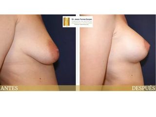 Antes y después Aumento pexia periareolar