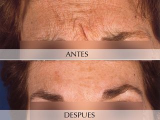 Antes y después Botox