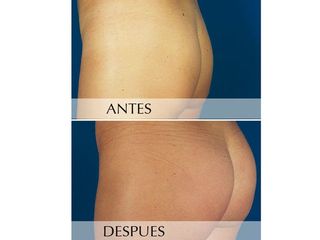 Antes y después Aumento de glúteos