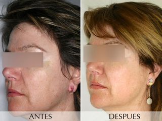 Antes y después Tratamiento con Luz Intensa Pulsada (IPL)