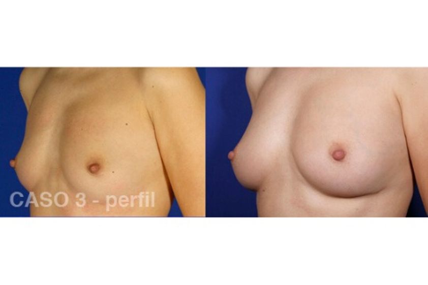 Lipofilling antes y después - 644990