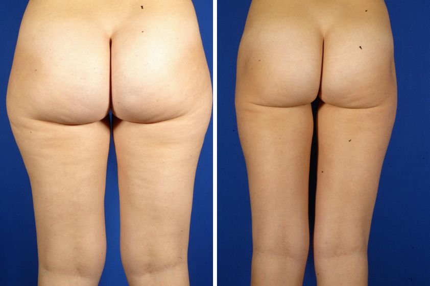 Lipo Vaser antes y después - 801568