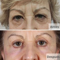 Blefaroplastia - Clínica Planas