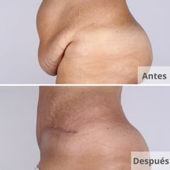 Abdominoplastia - Clínica Planas