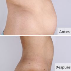 Lipo Vaser HD - Clínica Planas