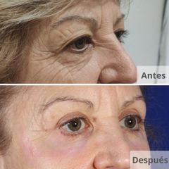 Blefaroplastia - Clínica Planas