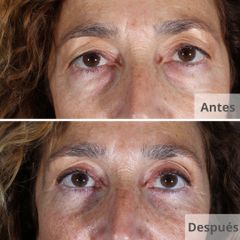 Blefaroplastia - Clínica Planas