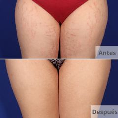 Varices - Clínica Planas