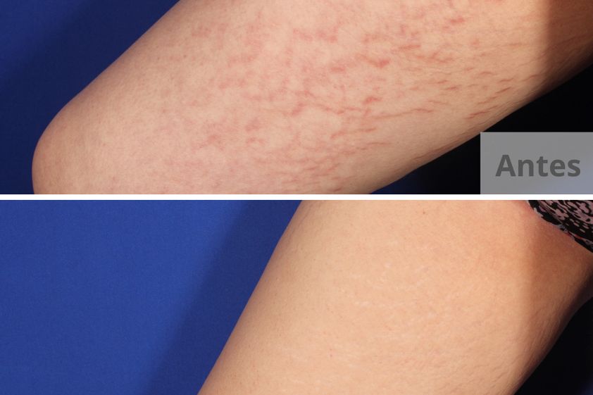 Tratamiento varices antes y después - 801609