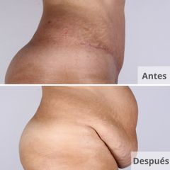 Abdominoplastia - Clínica Planas
